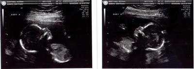Ultrasound – 18weeks